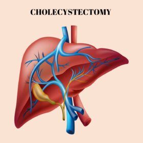CHOLECYSTECTOMY