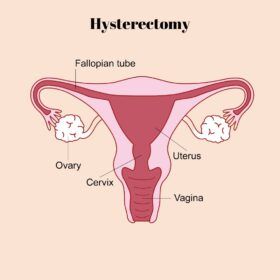 Hysterctomy - removing the uterus through surgery