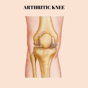 Total Knee Replacement - arthritic knee