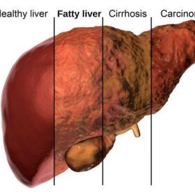 Non Alcholic Fatty Liver Diseases